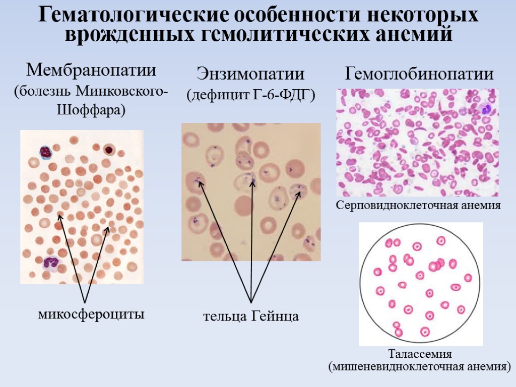 Анемия на фоне хбп